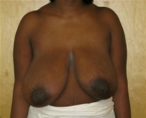 Breast Reduction Before Photo by Neal Goldberg, MD; Scarsdale, NY - Case 20726