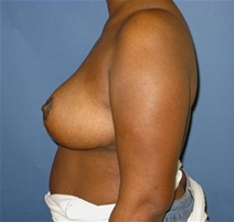 Breast Reduction After Photo by Neal Goldberg, MD; Scarsdale, NY - Case 20726