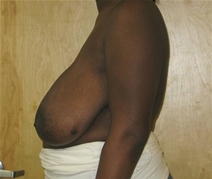 Breast Reduction Before Photo by Neal Goldberg, MD; Scarsdale, NY - Case 20726