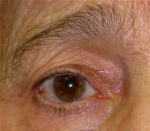 Eyelid Surgery Before Photo by Neal Goldberg, MD; Scarsdale, NY - Case 20727