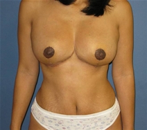 Breast Lift After Photo by Neal Goldberg, MD; Scarsdale, NY - Case 20832
