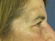 Eyelid Surgery After Photo by Neal Goldberg, MD; Scarsdale, NY - Case 21323