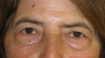 Eyelid Surgery Before Photo by Neal Goldberg, MD; Scarsdale, NY - Case 21323