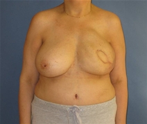 Breast Reconstruction After Photo by Neal Goldberg, MD; Scarsdale, NY - Case 21326