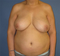 Breast Reconstruction Before Photo by Neal Goldberg, MD; Scarsdale, NY - Case 21326