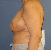 Breast Reconstruction After Photo by Neal Goldberg, MD; Scarsdale, NY - Case 21326