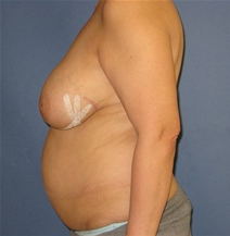 Breast Reconstruction Before Photo by Neal Goldberg, MD; Scarsdale, NY - Case 21326