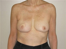 Breast Reconstruction After Photo by Neal Goldberg, MD; Scarsdale, NY - Case 21327