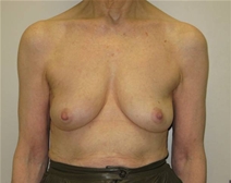 Breast Reconstruction Before Photo by Neal Goldberg, MD; Scarsdale, NY - Case 21327