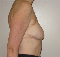 Breast Reconstruction After Photo by Neal Goldberg, MD; Scarsdale, NY - Case 21327