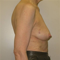 Breast Reconstruction Before Photo by Neal Goldberg, MD; Scarsdale, NY - Case 21327