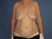 Breast Reconstruction Before Photo by Neal Goldberg, MD; Scarsdale, NY - Case 21328