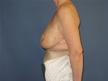 Breast Reconstruction After Photo by Neal Goldberg, MD; Scarsdale, NY - Case 21328