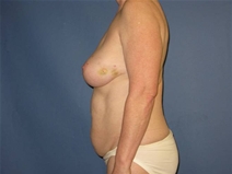 Breast Reconstruction Before Photo by Neal Goldberg, MD; Scarsdale, NY - Case 21328