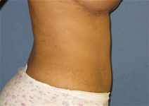 Liposuction After Photo by Neal Goldberg, MD; Scarsdale, NY - Case 21330