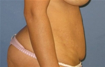 Liposuction Before Photo by Neal Goldberg, MD; Scarsdale, NY - Case 21330