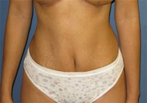 Tummy Tuck After Photo by Neal Goldberg, MD; Scarsdale, NY - Case 21331