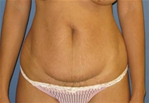 Tummy Tuck Before Photo by Neal Goldberg, MD; Scarsdale, NY - Case 21331