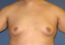 Male Breast Reduction Before Photo by Neal Goldberg, MD; Scarsdale, NY - Case 21334