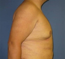 Male Breast Reduction After Photo by Neal Goldberg, MD; Scarsdale, NY - Case 21334
