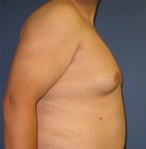Male Breast Reduction Before Photo by Neal Goldberg, MD; Scarsdale, NY - Case 21334