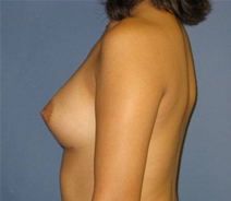 Breast Augmentation After Photo by Neal Goldberg, MD; Scarsdale, NY - Case 21372