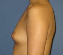 Breast Augmentation Before Photo by Neal Goldberg, MD; Scarsdale, NY - Case 21372