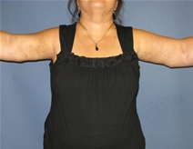 Arm Lift After Photo by Neal Goldberg, MD; Scarsdale, NY - Case 21534