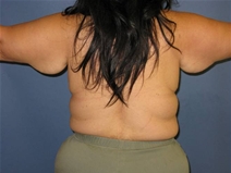 Arm Lift Before Photo by Neal Goldberg, MD; Scarsdale, NY - Case 21534