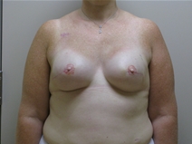 Breast Reconstruction After Photo by Neal Goldberg, MD; Scarsdale, NY - Case 21535
