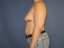 Breast Reconstruction Before Photo by Neal Goldberg, MD; Scarsdale, NY - Case 21535