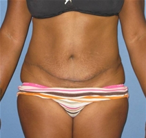 Tummy Tuck After Photo by Neal Goldberg, MD; Scarsdale, NY - Case 21536