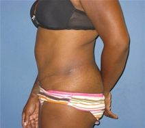 Tummy Tuck After Photo by Neal Goldberg, MD; Scarsdale, NY - Case 21536
