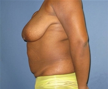 Tummy Tuck Before Photo by Neal Goldberg, MD; Scarsdale, NY - Case 21536