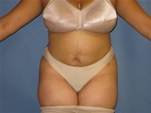 Liposuction After Photo by Neal Goldberg, MD; Scarsdale, NY - Case 21684