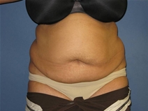 Liposuction Before Photo by Neal Goldberg, MD; Scarsdale, NY - Case 21684
