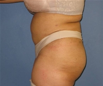 Liposuction After Photo by Neal Goldberg, MD; Scarsdale, NY - Case 21684