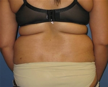 Liposuction Before Photo by Neal Goldberg, MD; Scarsdale, NY - Case 21684