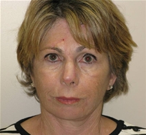 Facelift After Photo by Neal Goldberg, MD; Scarsdale, NY - Case 21761
