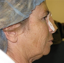 Facelift Before Photo by Neal Goldberg, MD; Scarsdale, NY - Case 21761