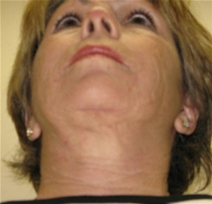 Facelift After Photo by Neal Goldberg, MD; Scarsdale, NY - Case 21761