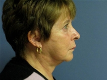 Facelift After Photo by Neal Goldberg, MD; Scarsdale, NY - Case 21885