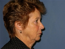 Facelift Before Photo by Neal Goldberg, MD; Scarsdale, NY - Case 21885