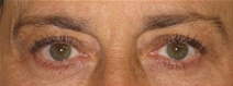 Eyelid Surgery After Photo by Neal Goldberg, MD; Scarsdale, NY - Case 21886