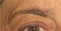 Eyelid Surgery Before Photo by Neal Goldberg, MD; Scarsdale, NY - Case 21886
