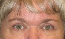 Eyelid Surgery After Photo by Neal Goldberg, MD; Scarsdale, NY - Case 21965