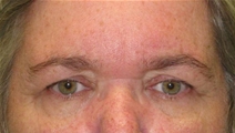 Eyelid Surgery Before Photo by Neal Goldberg, MD; Scarsdale, NY - Case 21965