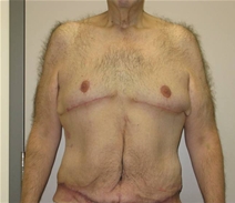 Male Breast Reduction After Photo by Neal Goldberg, MD; Scarsdale, NY - Case 21966