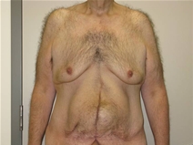 Male Breast Reduction Before Photo by Neal Goldberg, MD; Scarsdale, NY - Case 21966