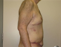 Male Breast Reduction After Photo by Neal Goldberg, MD; Scarsdale, NY - Case 21966